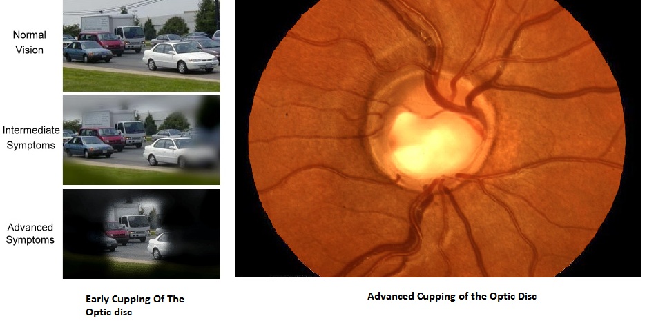 Glaucoma Optic Nerve