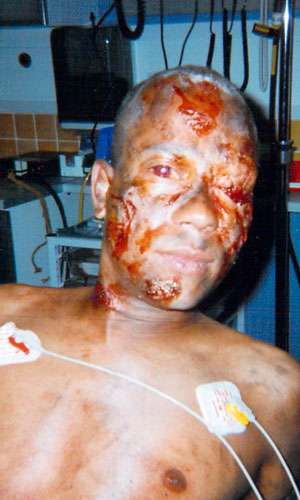 Bomb-Blast Casualty TV Series Contact Lenses