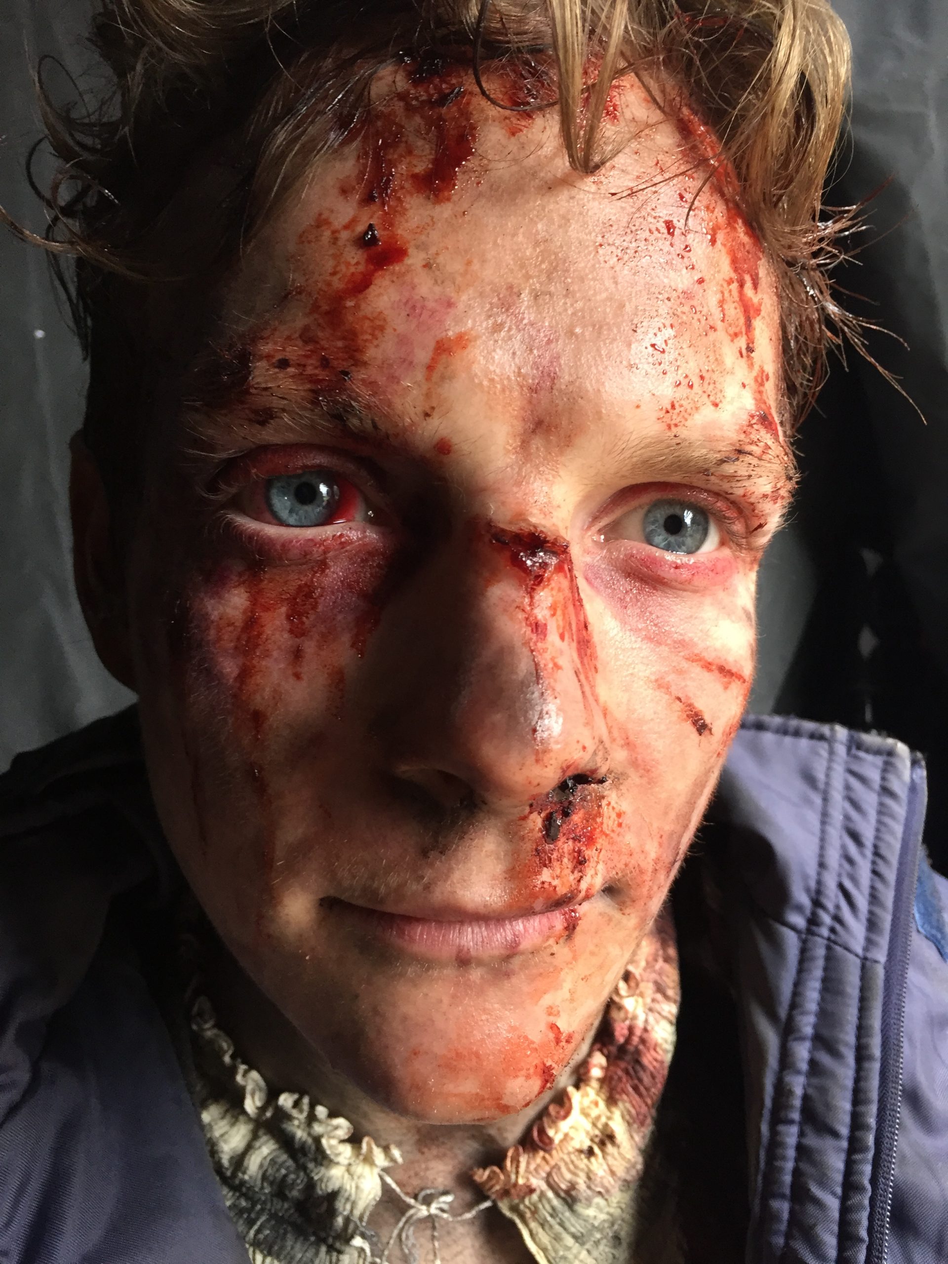 Punched right eye haemorrhage Bristol Cosmetic Contact Lens for TV Series