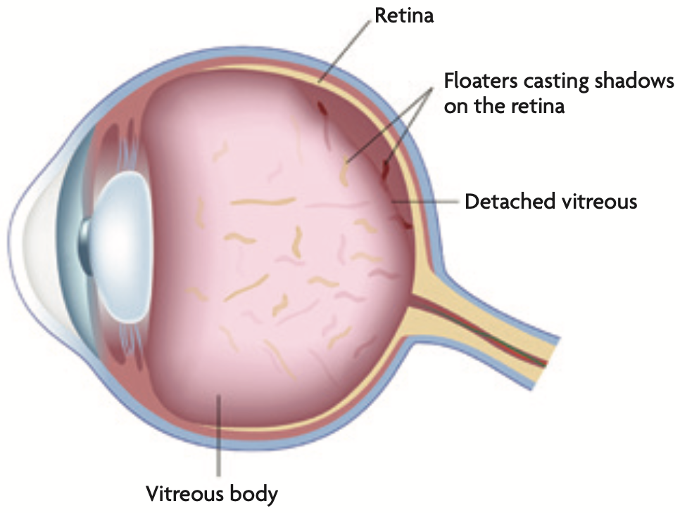 retina Retinal Detachment - Flashers and Floaters