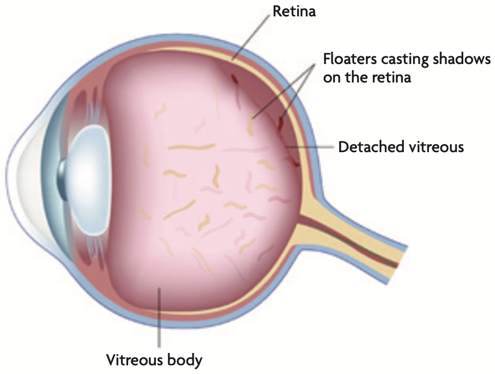 Retinal Detachment - Flashers and Floaters