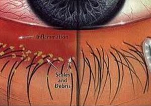 Gritty Eye Inflammation