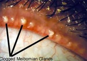 Clogged Meiobmian Glands: Sore Eeyes