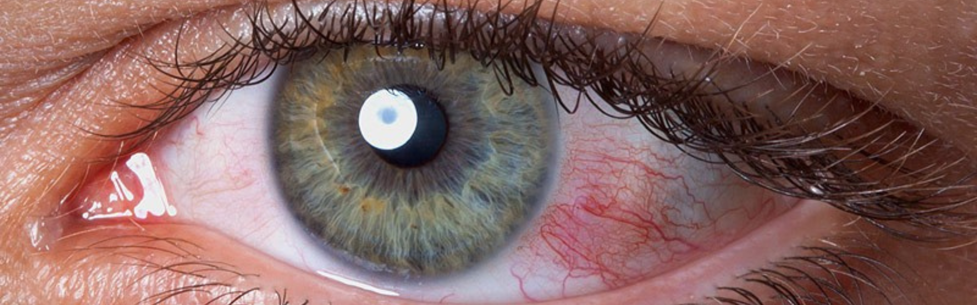 Dry Eye Syndrome
