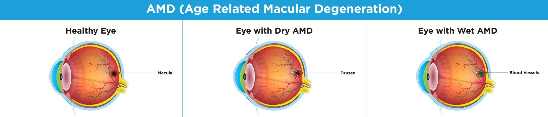 age-related-macular-degeneration-vision-eyes