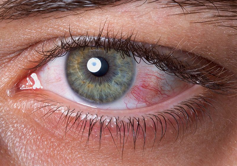 Sore Eyes: Symptom of Dry Eye
